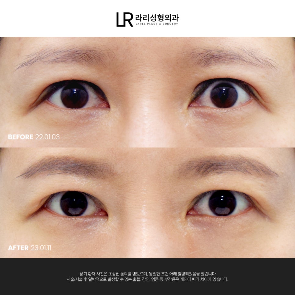 [라리성형외과]  부리부리한 사백안 눈 토안, 이런 눈도 교정 가능할까요 ? 관련 이미지 4