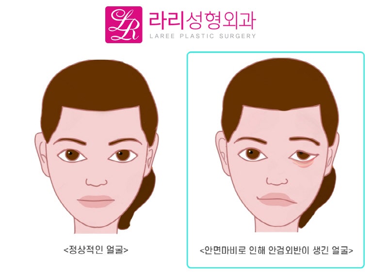 [Lari Plastic Surgery] What Is Ectropion? The Definition and Causes of Ectropion image 4