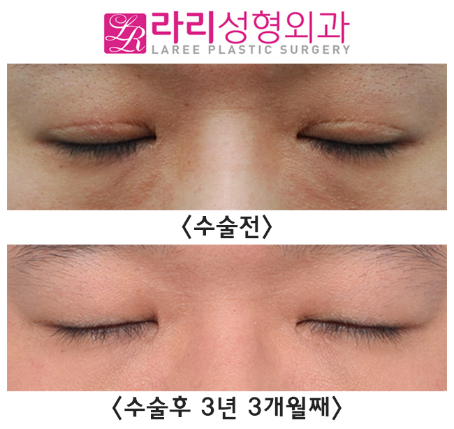 [Rari Plastic Surgery] Scar After Incisional Double Eyelid Surgery, Reversal Side Effects, and Correction of Uneven Eyelids with Double Eyelid Removal Surgery image 1