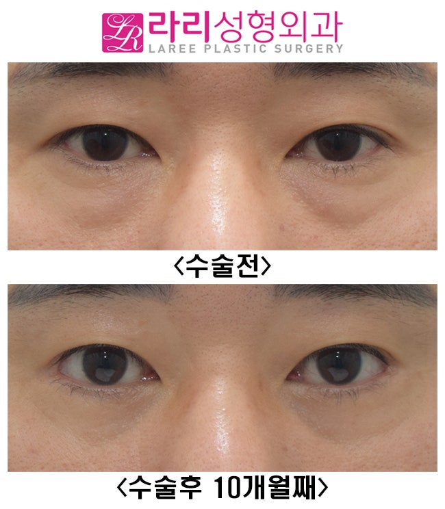 [라리성형외과] 남자 눈꼬리내리기 뒤트임수술 후 변화 관련 이미지 1