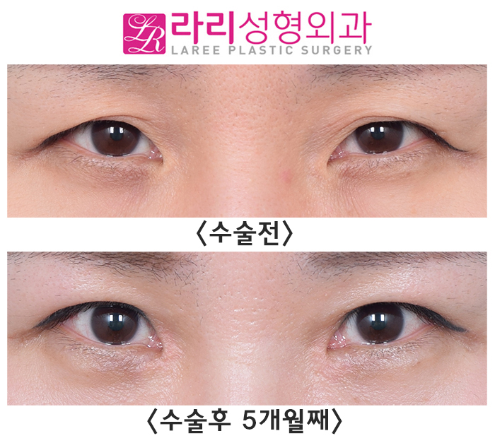 [라리성형외과] 자연스러운 속쌍꺼풀 절개눈매교정, 앞트임수술 전후사진 관련 이미지 1