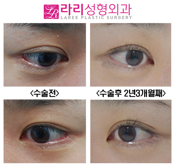 [라리성형외과] 최소한의 뒤트임 복원수술로 최대한의 효과를(+쌍수 짝짝이 교정) 관련 이미지 3
