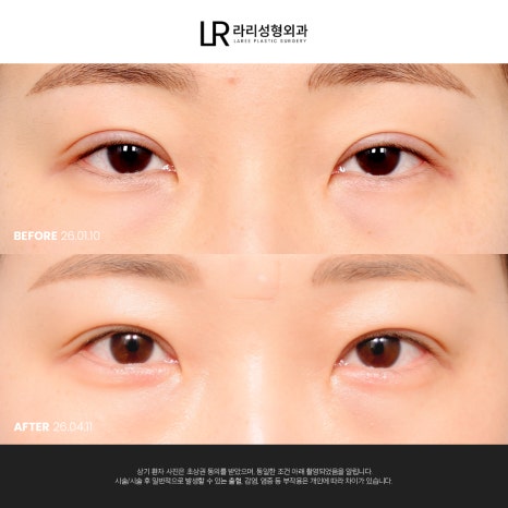 [라리성형외과] 눈 (재) 수술은 라리성형외과가 관련 이미지 7
