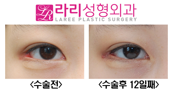 [라리성형외과] 다양한 뒤트임복원수술 전후사진 관련 이미지 1