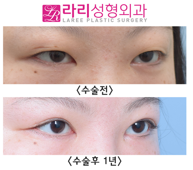 [라리성형외과] 절개눈매교정 자연스러운 인라인 속쌍 + 눈꺼풀 패인 흉터교정 관련 이미지 3