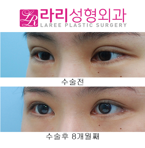 [라리성형외과] 쌍꺼풀재수술 소세지교정, 뒤트임재수술 관련 이미지 4