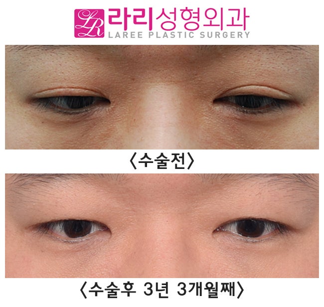 [Rari Plastic Surgery] Scar After Incisional Double Eyelid Surgery, Reversal Side Effects, and Correction of Uneven Eyelids with Double Eyelid Removal Surgery image 3