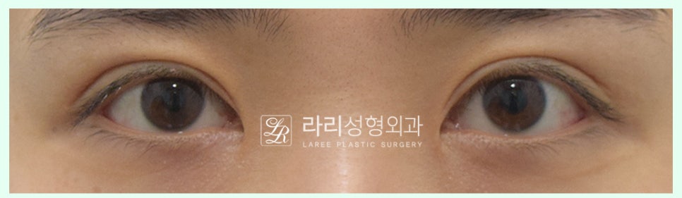 [Lari Plastic Surgery] Removing a Visible Double Eyelid (Double Eyelid Reversal Surgery), From Natural Double Eyelids to Surgical Double Eyelids: A to Z image 5