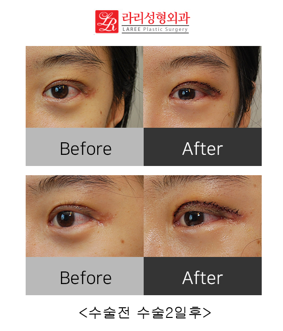 Correcting Double Eyelid Surgery Side Effects: Ectropion (feat. Rari Plastic Surgery) image 2