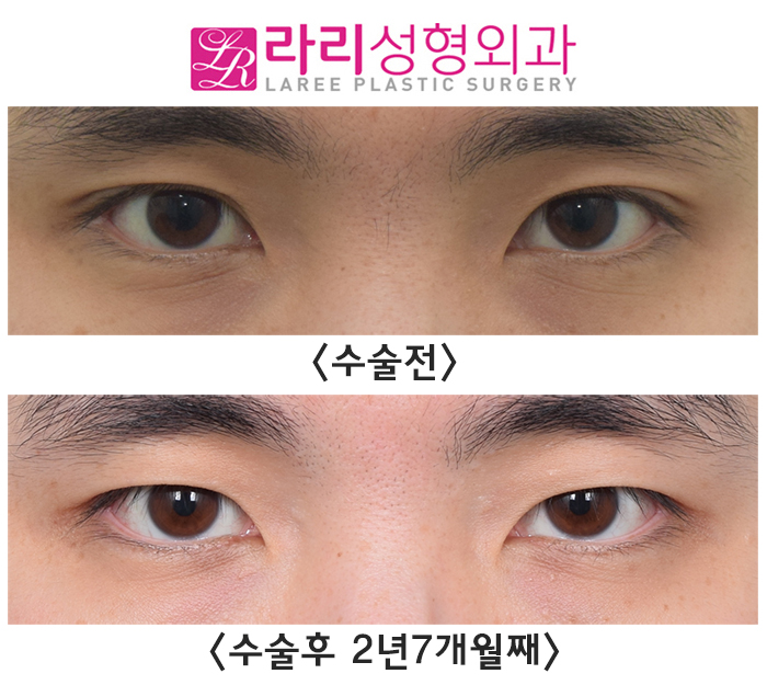 [Lari Plastic Surgery] Long-Term Before-and-After Photos of Surgery to Remove Double Eyelids and Create a Natural Single Eyelid Look image 3