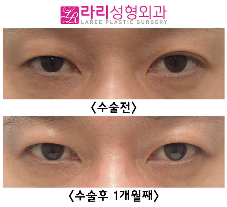 [라리성형외과] 쌍커풀 없애는 수술 후 회복이 빠른 경우 전후 사진 관련 이미지 1
