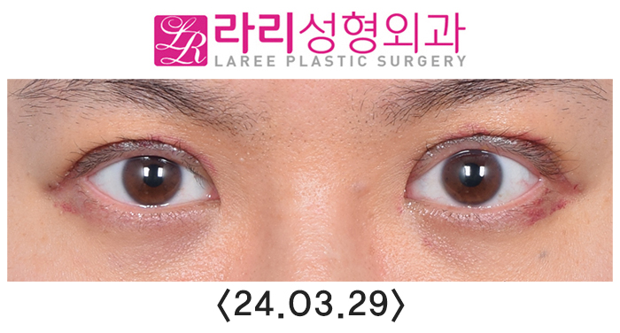 [라리성형외과] 쌍꺼풀없애는수술 후 필요에 의한 재교정과 회복 과정 기간별 사진 관련 이미지 2