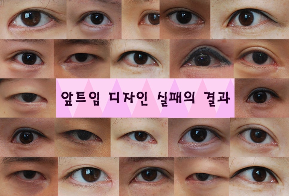 몽고주름, 더이상 헤매지말고 트임없는앞트임으로! 관련 이미지 2