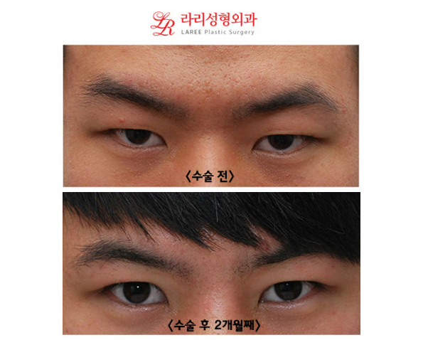 Natural-looking non-incisional eye correction surgery for men with single eyelids is the trend! image 6