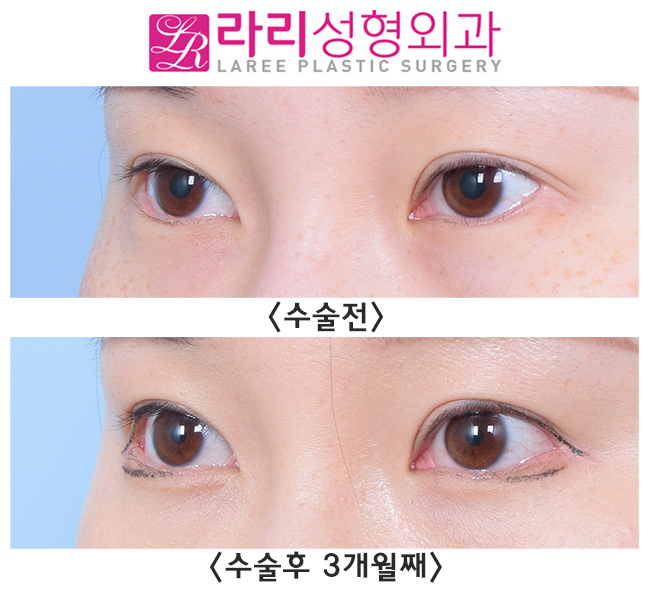 [라리성형외과] 눈꼬리내리기뒤트임효과 확실히 보는 눈 관련 이미지 2