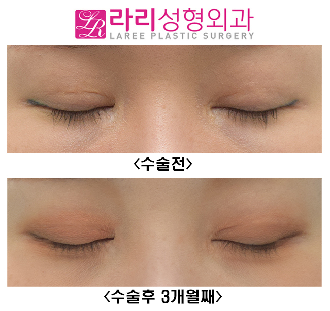 [Lari Plastic Surgery] If You Want to Be Sure of the Effect of Revision Lateral Canthoplasty, Do It Together with Revision Double Eyelid Surgery (Ptosis Correction Surgery). image 4
