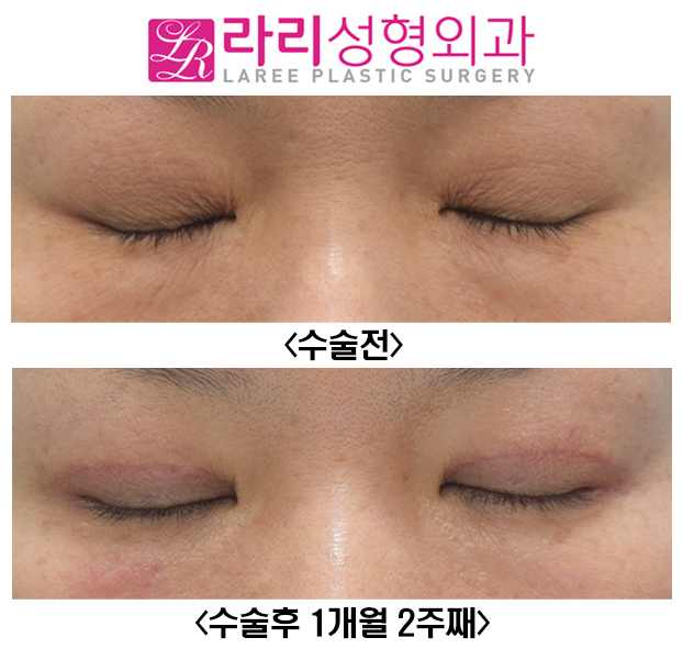 [라리성형외과] 자연스러운 절개눈매교정과 함께한 눈꼬리내리기뒤트임 수술전후 관련 이미지 4