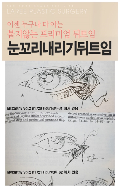 Revision of Lateral Canthoplasty - Fixation Method, Scar Correction, Recovery, and More image 4