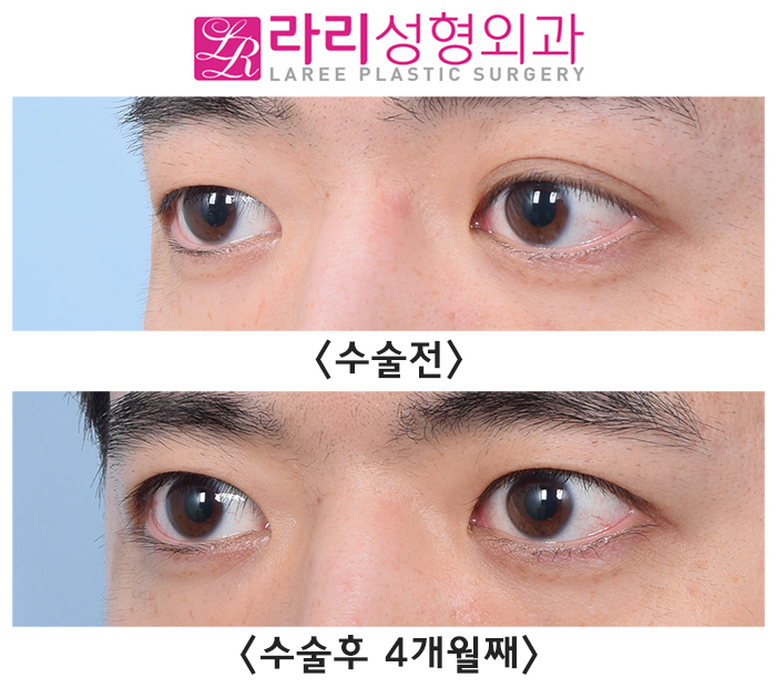 [라리성형외과] 교정과 예방을 모두 위한 쌍꺼풀없애기수술 전후 사진 관련 이미지 2