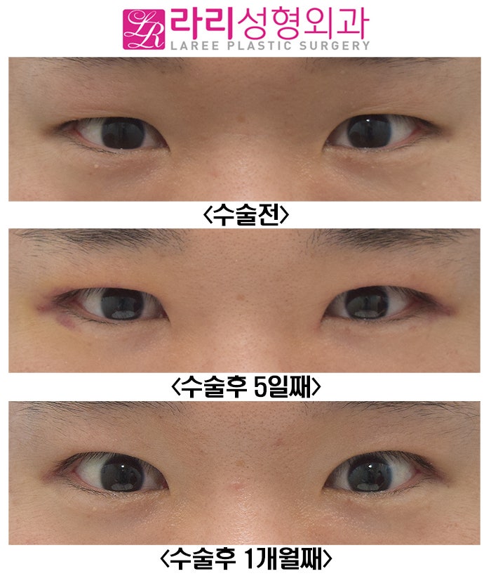 [Rari Plastic Surgery] Recovery Progress After Male Incisional Eye Opening Correction and Double-Eyelid-Free Eye Opening Correction Surgery: Natural and Neat image 2