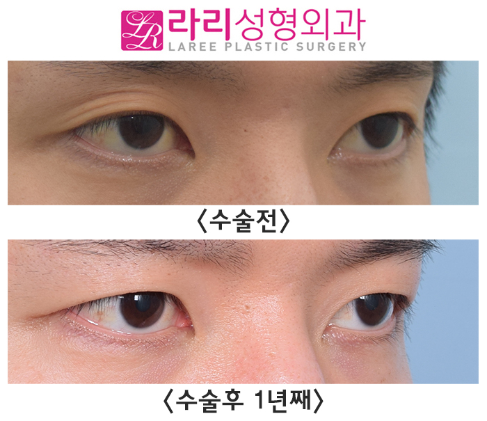 [라리성형외과] 여러 가지 쌍꺼풀 생기는 눈 무쌍으로 바꿔드립니다. 관련 이미지 7