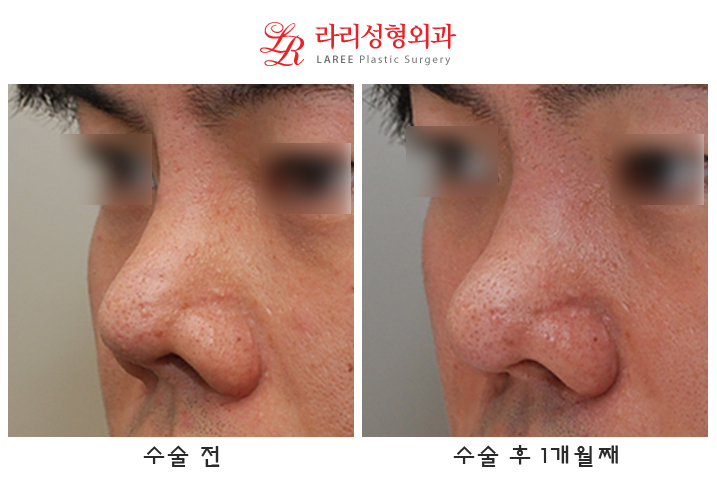 Correction of Upturned Nose and Contracted Nose, Revision Rhinoplasty Using Autologous Tissue (feat. Ear Cartilage) image 5