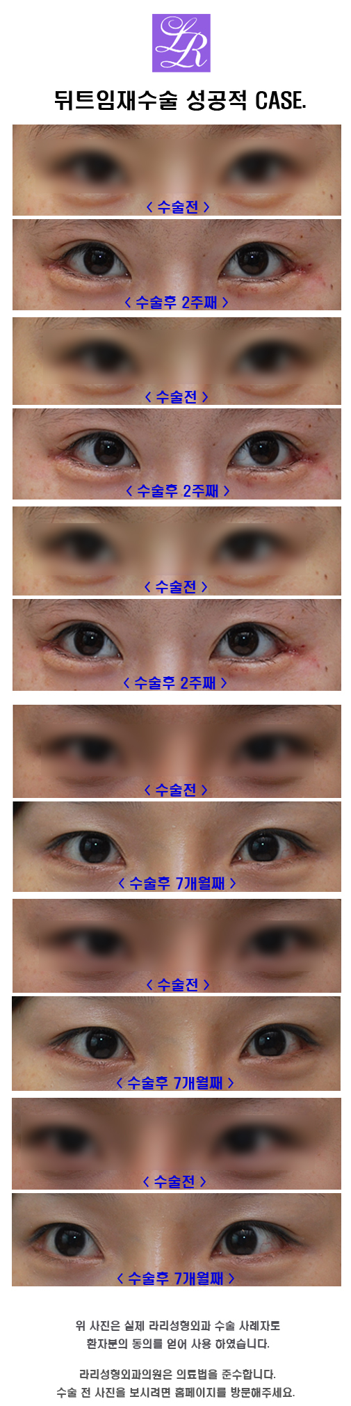 Why Revision Surgery Is Common for Outer Corner Eye Surgery image 7