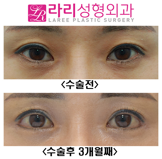 [Lari Plastic Surgery] Before-and-After Photos 3 Months After First Canthoplasty image 1