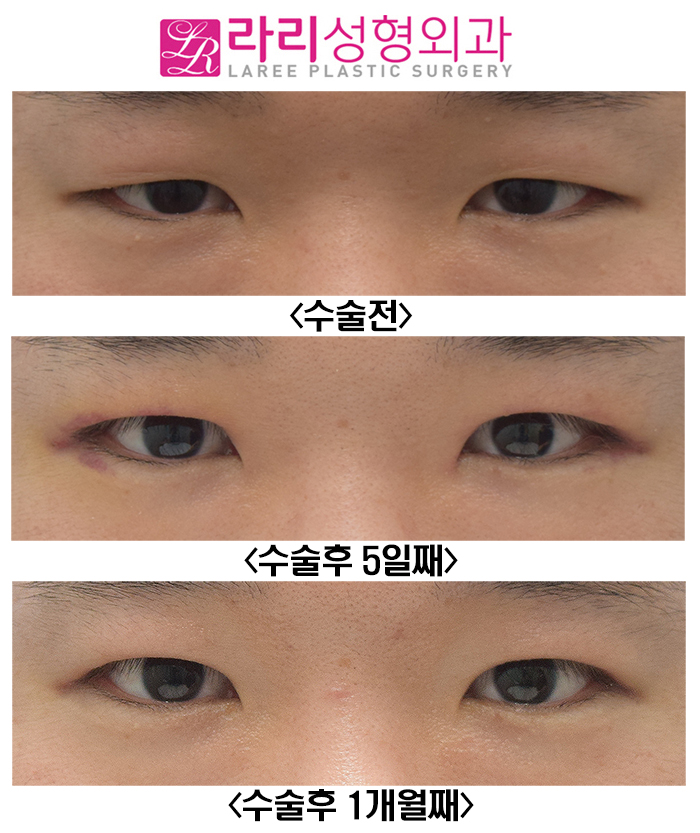 [Rari Plastic Surgery] Recovery Progress After Male Incisional Eye Opening Correction and Double-Eyelid-Free Eye Opening Correction Surgery: Natural and Neat image 1