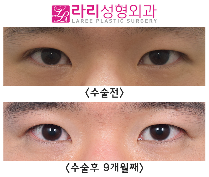 [Rari Plastic Surgery] Revision Surgery to Remove a Double Eyelid Is Also Possible. image 1