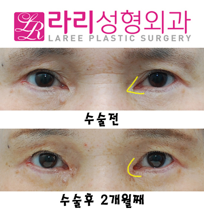 눈앞쪽 여러겹 쌍거풀없애기+뾰족한누호 둥글게 만들기 관련 이미지 3