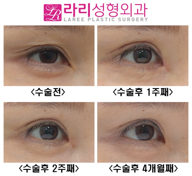 [Lari Plastic Surgery] If you’re worried that epicanthoplasty restoration may make your eyes look too cramped, consider non-incisional epicanthoplasty. image 2