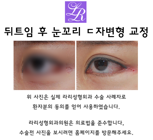 Why Revision Surgery Is Common for Outer Corner Eye Surgery image 4