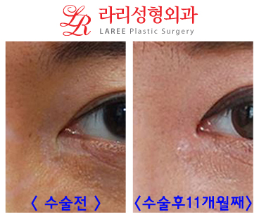 앞트임흉터제거 및 앞트임복원/앞트임재건의 효과를 알아보자! 관련 이미지 9