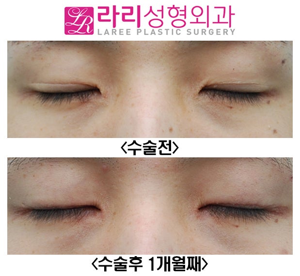 [Rari Plastic Surgery] Removing Double Eyelids Without a Crease and Medial Canthoplasty Are Effective for Changing the Look image 4
