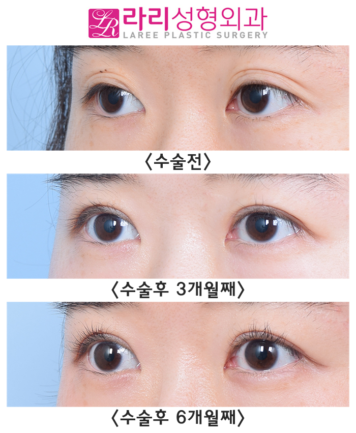 [Lari Plastic Surgery] Changes in Double Eyelid Line Over Time After Revision Surgery for Loosening Side Effects image 5