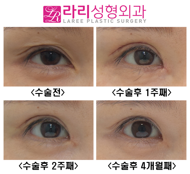 [Lari Plastic Surgery] If you’re worried that epicanthoplasty restoration may make your eyes look too cramped, consider non-incisional epicanthoplasty. image 1