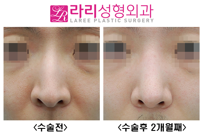 [Lari Plastic Surgery] Hump Nose Surgery Without an Implant image 1