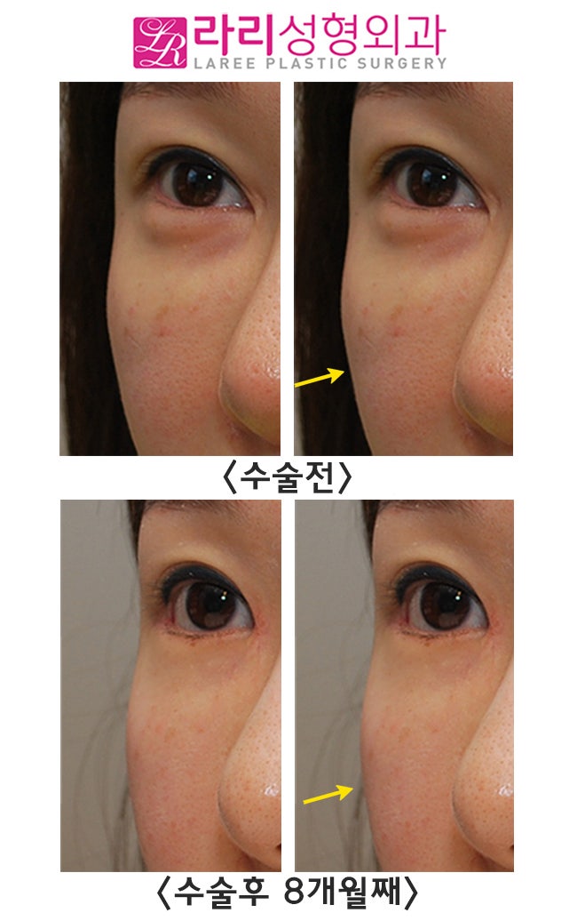 [Lali Plastic Surgery] Comparison Photos of the Before-and-After Differences of Epicanthoplasty Restoration, Revision Lateral Canthoplasty, and Fat Graft Removal Surgery (Under-Eye + Cheekbone Area) image 6