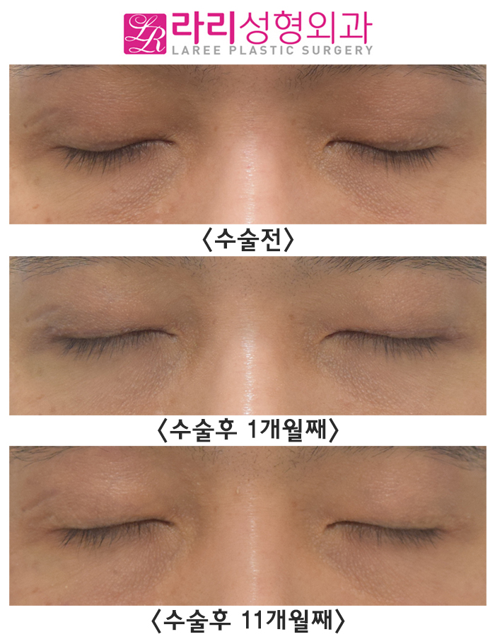 [Lari Plastic Surgery] Surgery to Remove Double Eyelids, Questions After Surgery. (Completely monolid? Upsetting because it is close to a monolid?) image 3