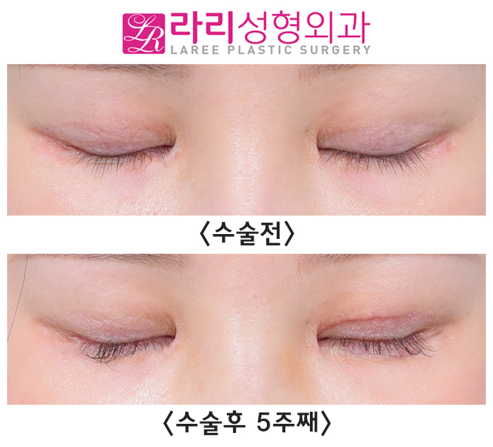 [라리성형외과] 한쪽 쌍수 재수술로 짝눈을 맞춰요. (절개쌍수라인낮추기) 관련 이미지 3