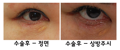 Complications of Lower Blepharoplasty: Ectropion Correction (Senile, Traumatic, Iatrogenic) image 3