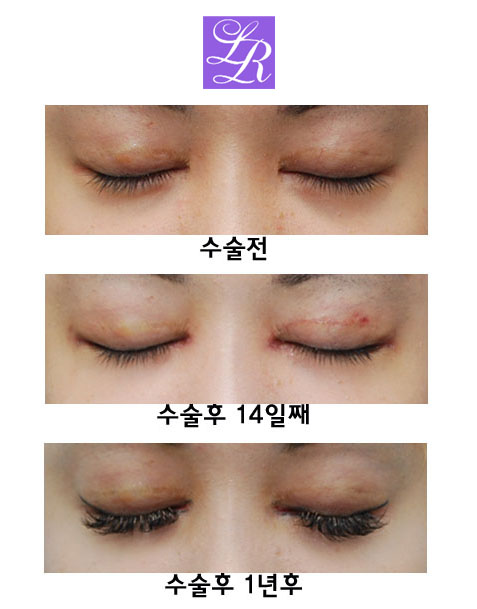 Simultaneous Medial and Lateral Canthoplasty Revision image 2
