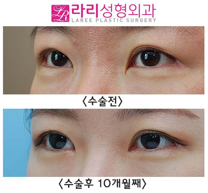 [라리성형외과] 트임없는앞트임, 분명 텄는데 터지지 않았습니다. 갈고리 몽고주름만 없앴습니다. 관련 이미지 2