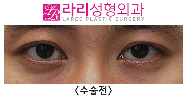 [라리성형외과] 쌍꺼풀없애는수술 단기 회복부터 장기 경과까지 관련 이미지 1