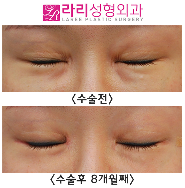 [Lali Plastic Surgery] Comparison Photos of the Before-and-After Differences of Epicanthoplasty Restoration, Revision Lateral Canthoplasty, and Fat Graft Removal Surgery (Under-Eye + Cheekbone Area) image 2