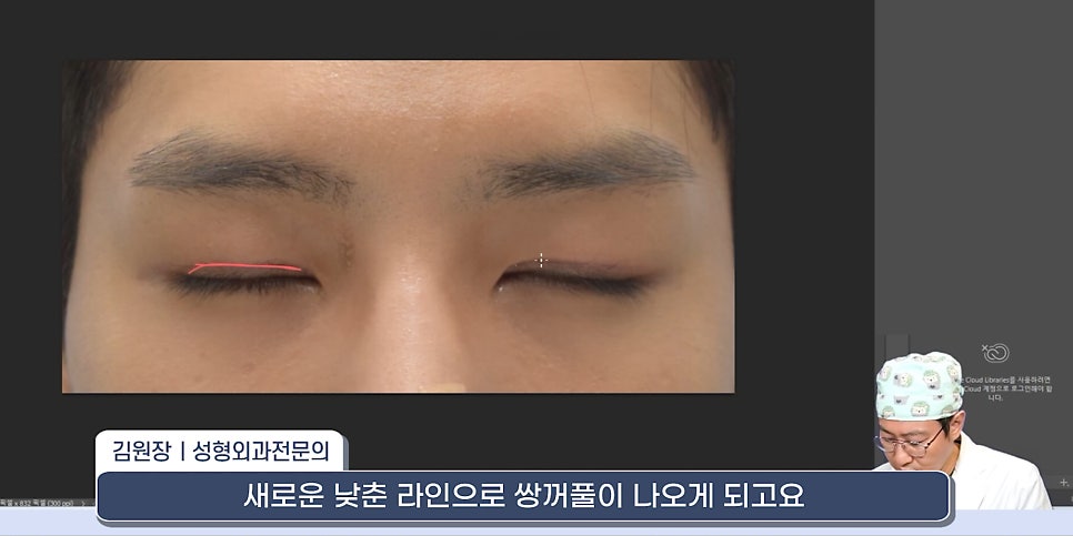 [라리성형외과] 쌍꺼풀재수술 라인 낮추는 두 가지 수술법 (절제방법 , 두줄따기방법) 관련 이미지 7