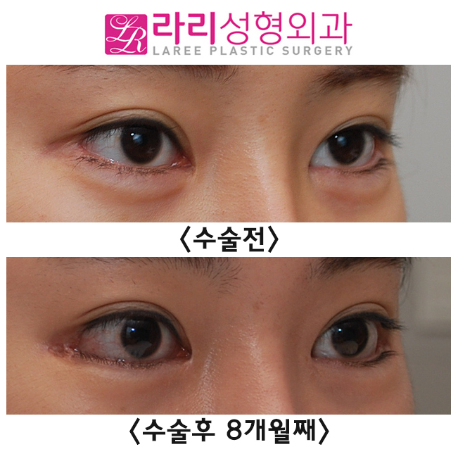 [라리성형외과] 벌어짐 없는 앞트임 미세복원 관련 이미지 2