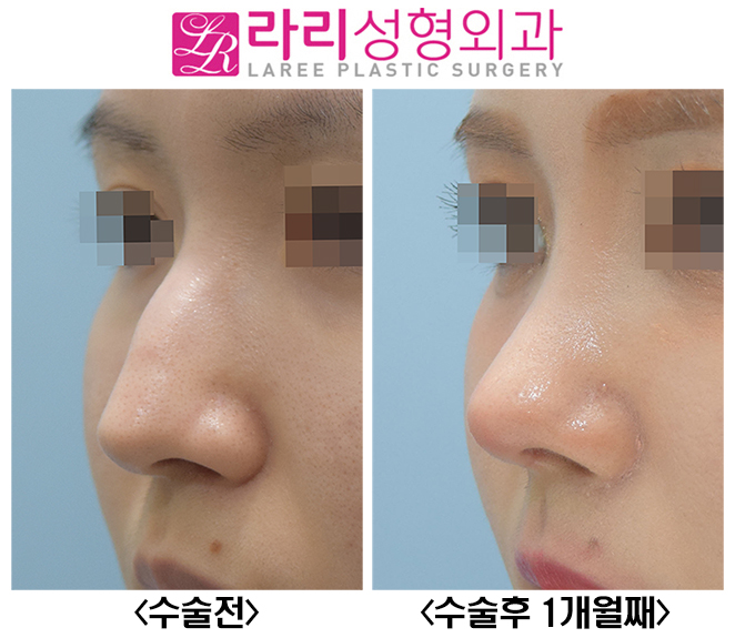 [라리성형외과] 매부리코수술, 무보형물로 자연스럽고 매끈하게 관련 이미지 4