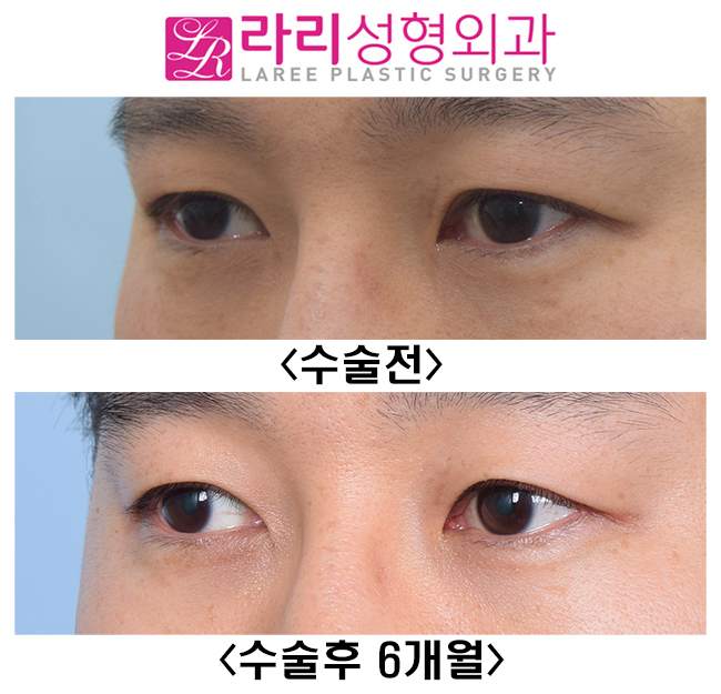 [라리성형외과] 눈을 떠도 눈을 감아도 쌍꺼풀이 없는 쌍꺼풀없애기 관련 이미지 5